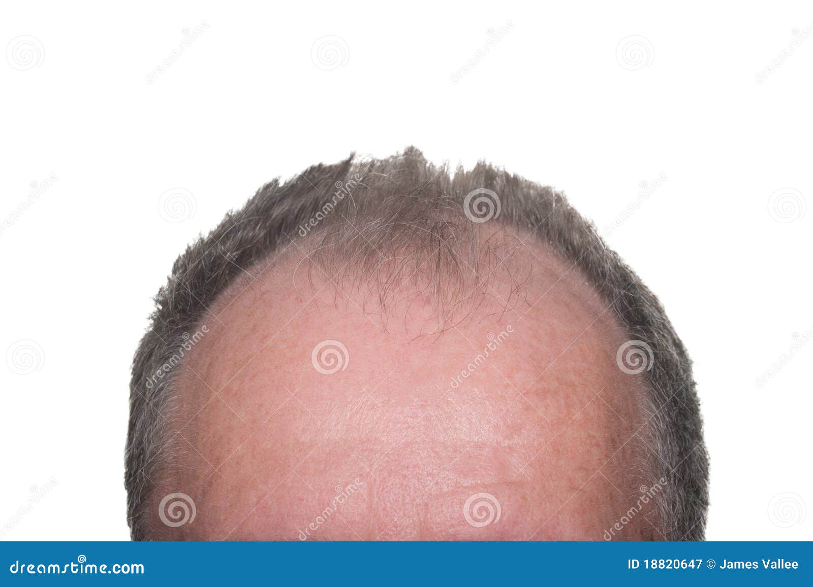 Male Pattern Baldness stock image. Image of hairline - 18820647