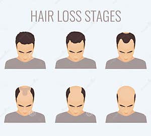 Baldness Stages Vector Set CartoonDealer 77369875