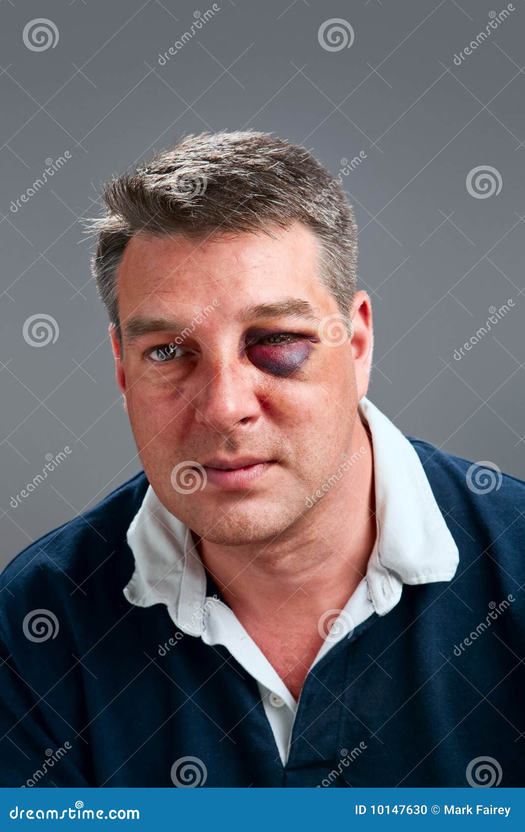 male-portrait-bruised-eye-10147630.jpg