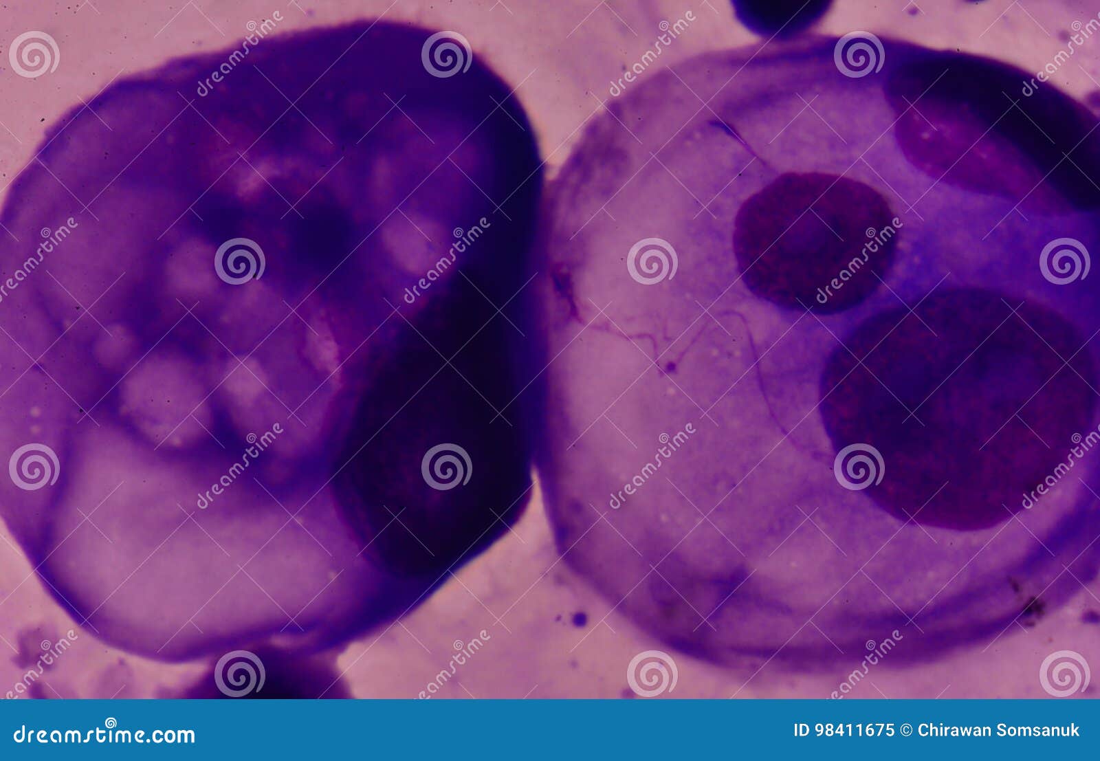 uterine papillary mesothelioma