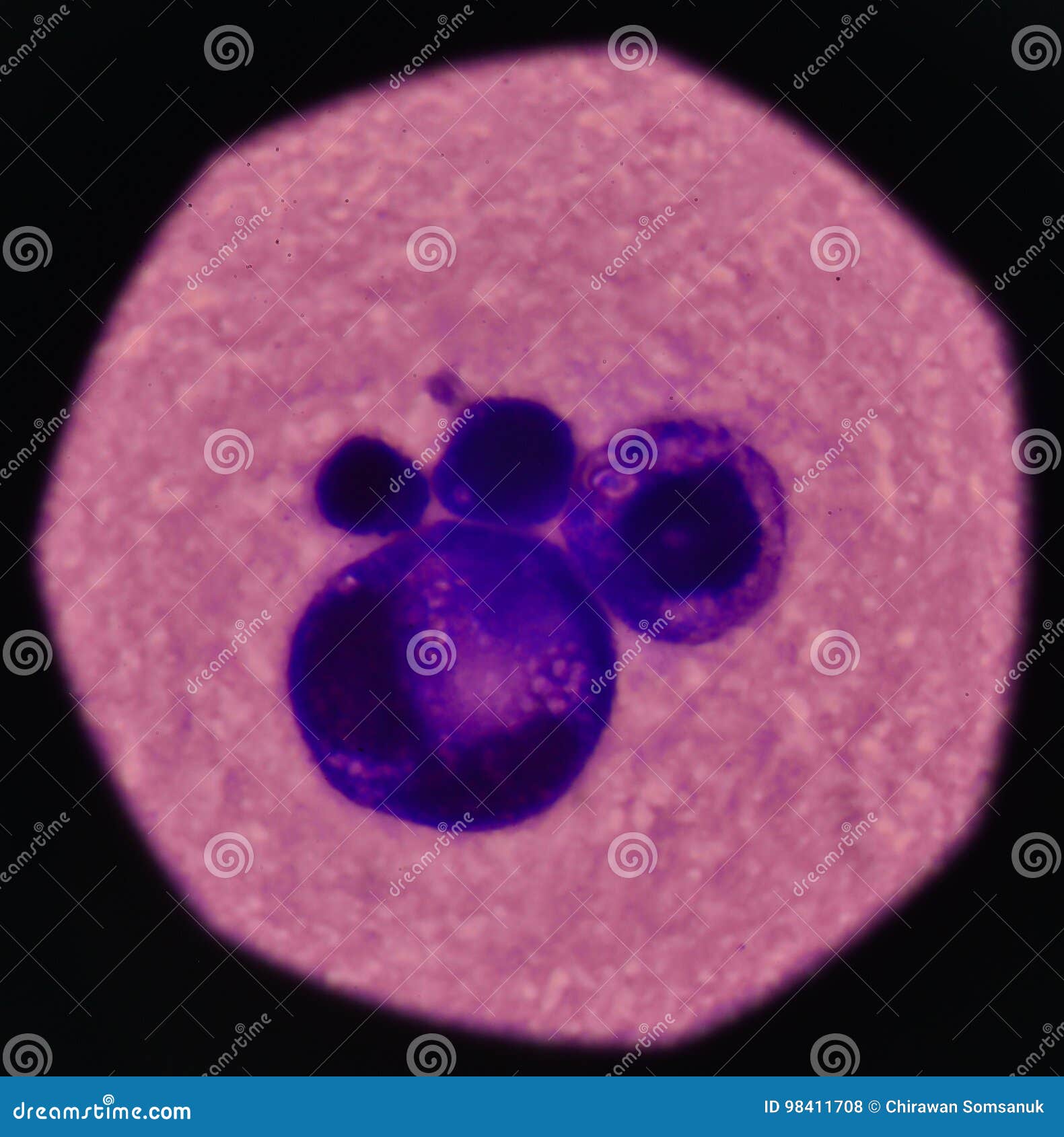 peritoneal cancer spread to bones