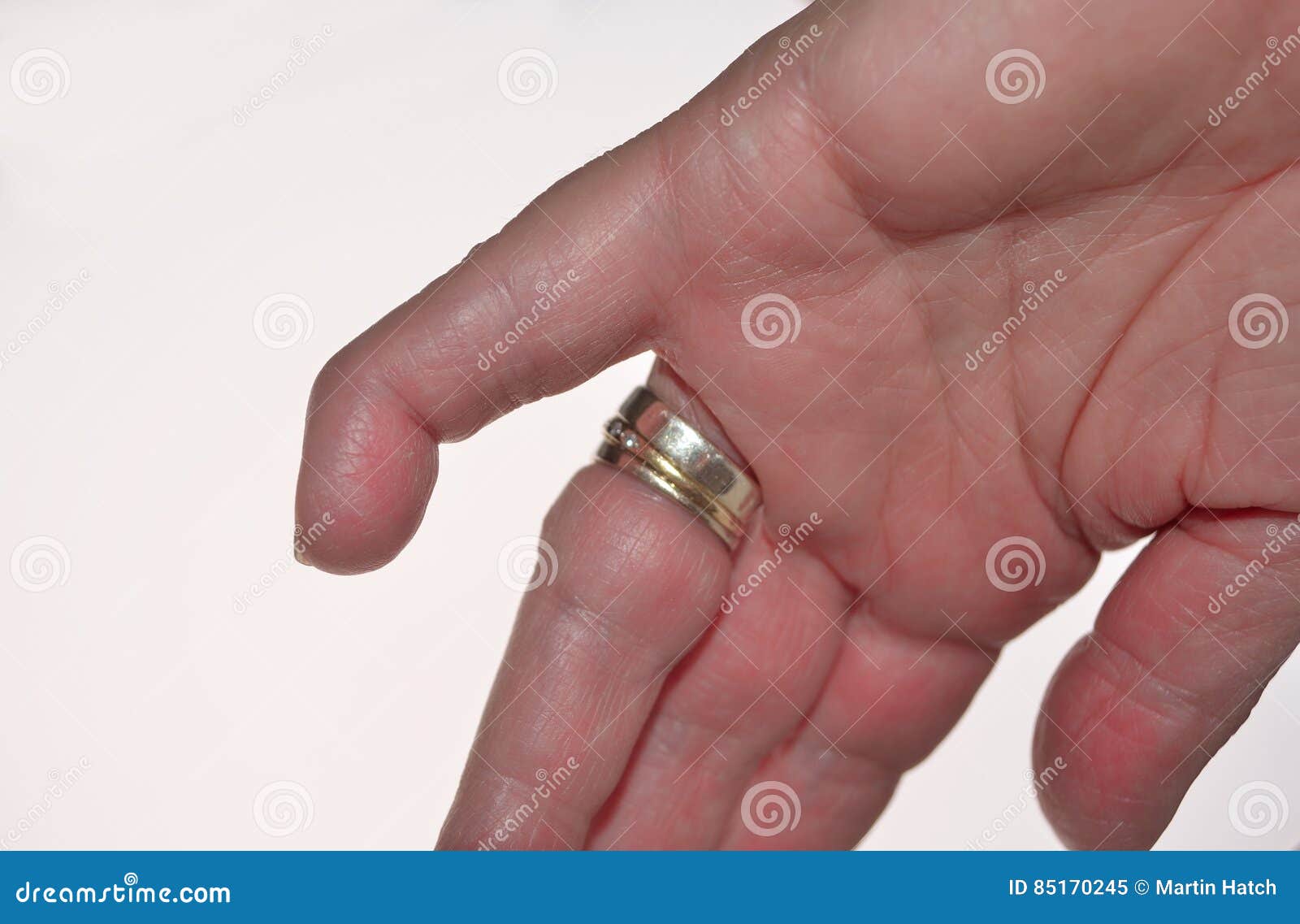 A mallet finger stock image. Image of medicine, anatomy 85170245