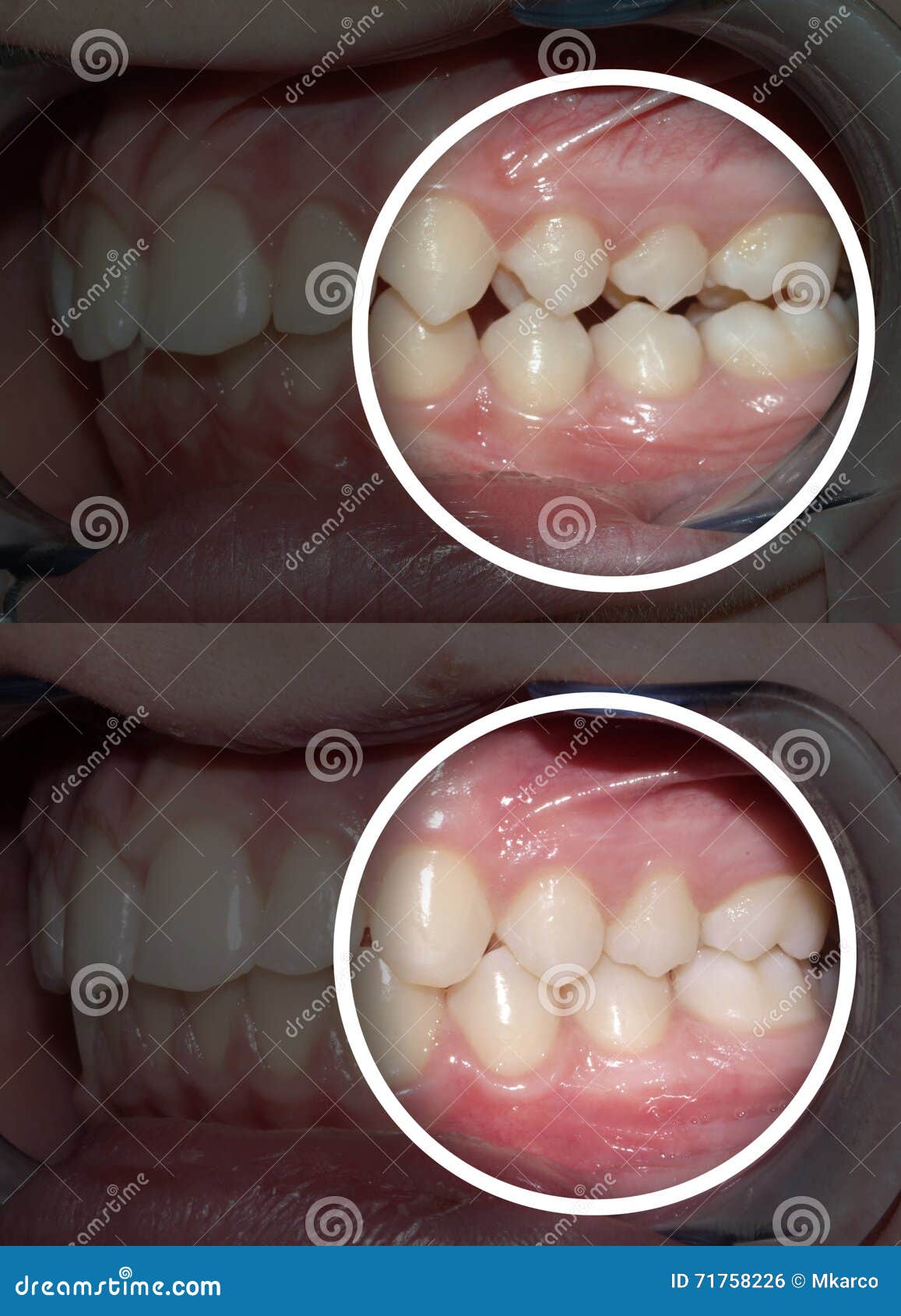 Malocclusion after and before Orthodontic Treatment Stock Photo Image