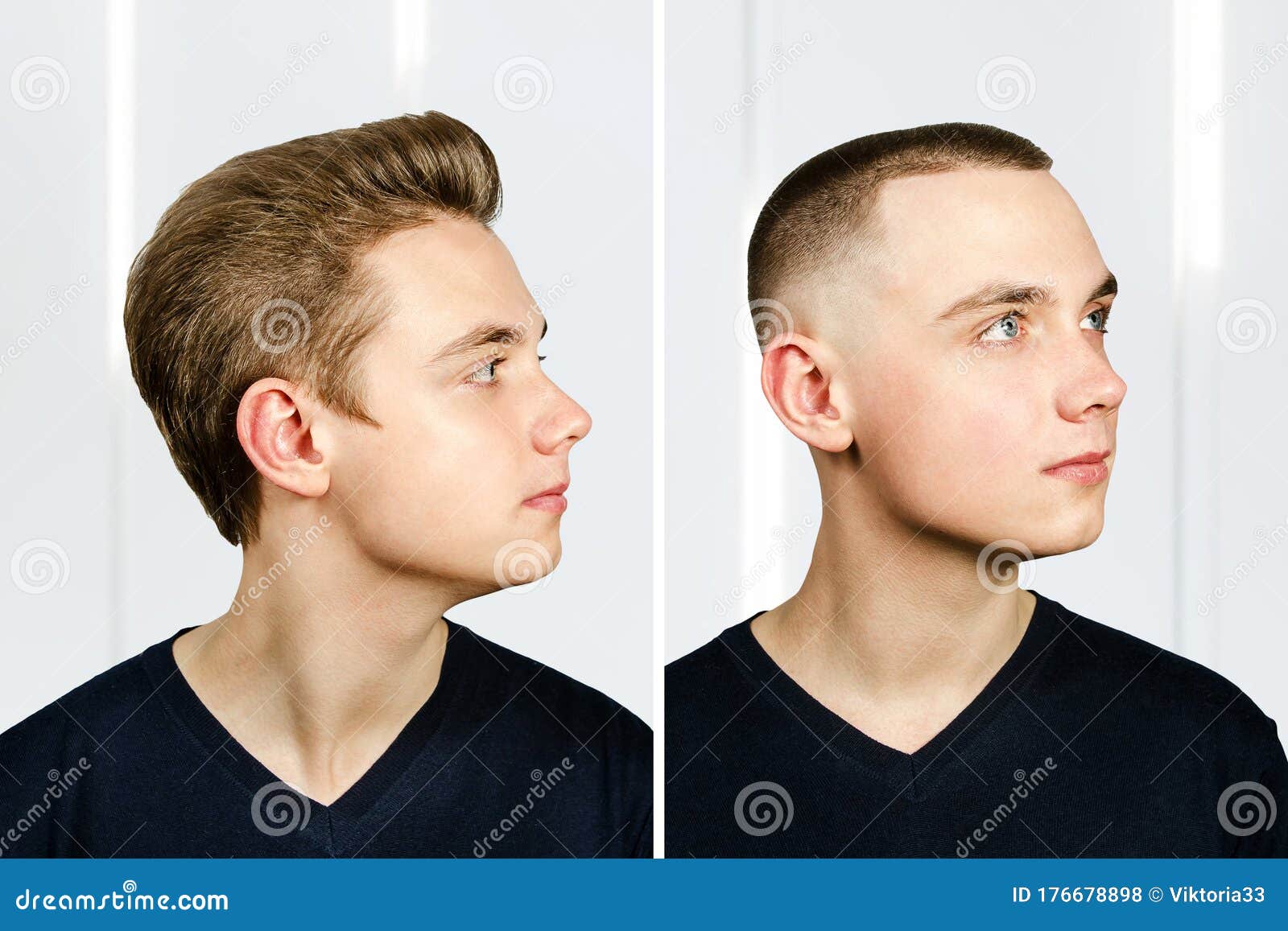 Man before Arter Haircut with Hair Loss: Bald and Pompadour, Transplant and  Transformation in Profile Fade Side Stock Photo - Image of loss, shop:  176678898