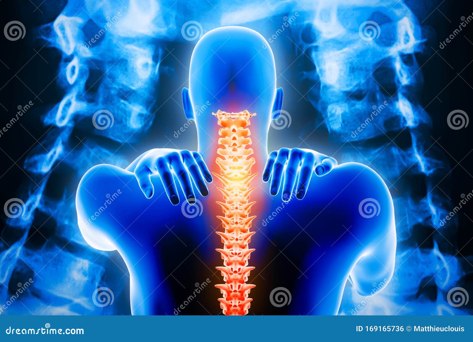man back body with spine and x-ray vertebrae imagery in the background. neck pain or cervicalgia, backbone or cervical injury 3d