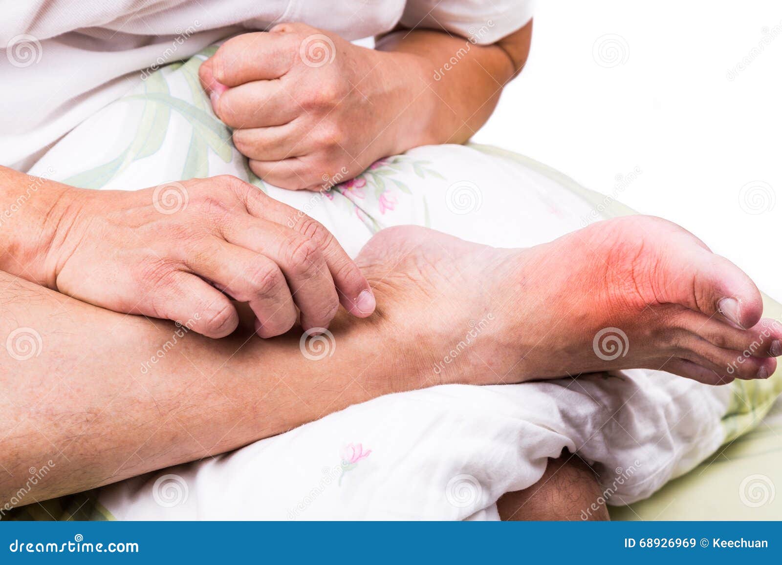 man on bed embrace foot with painful swollen gout inflammation