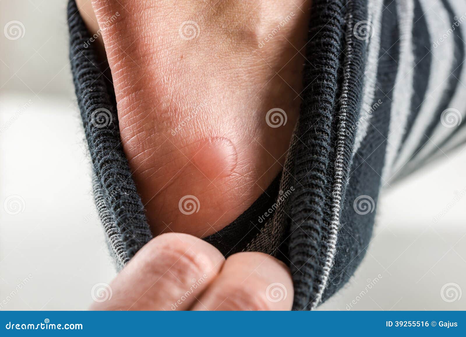 man with a blister on his heel
