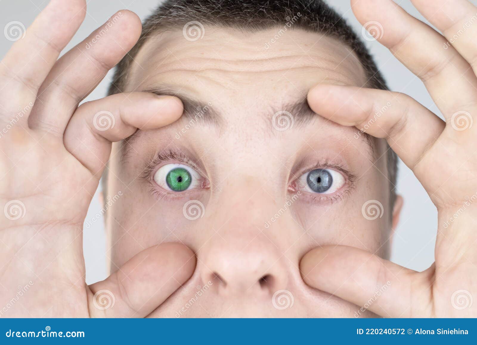A Man with Different Color Eyes Looks into the Frame. the Right Eye is