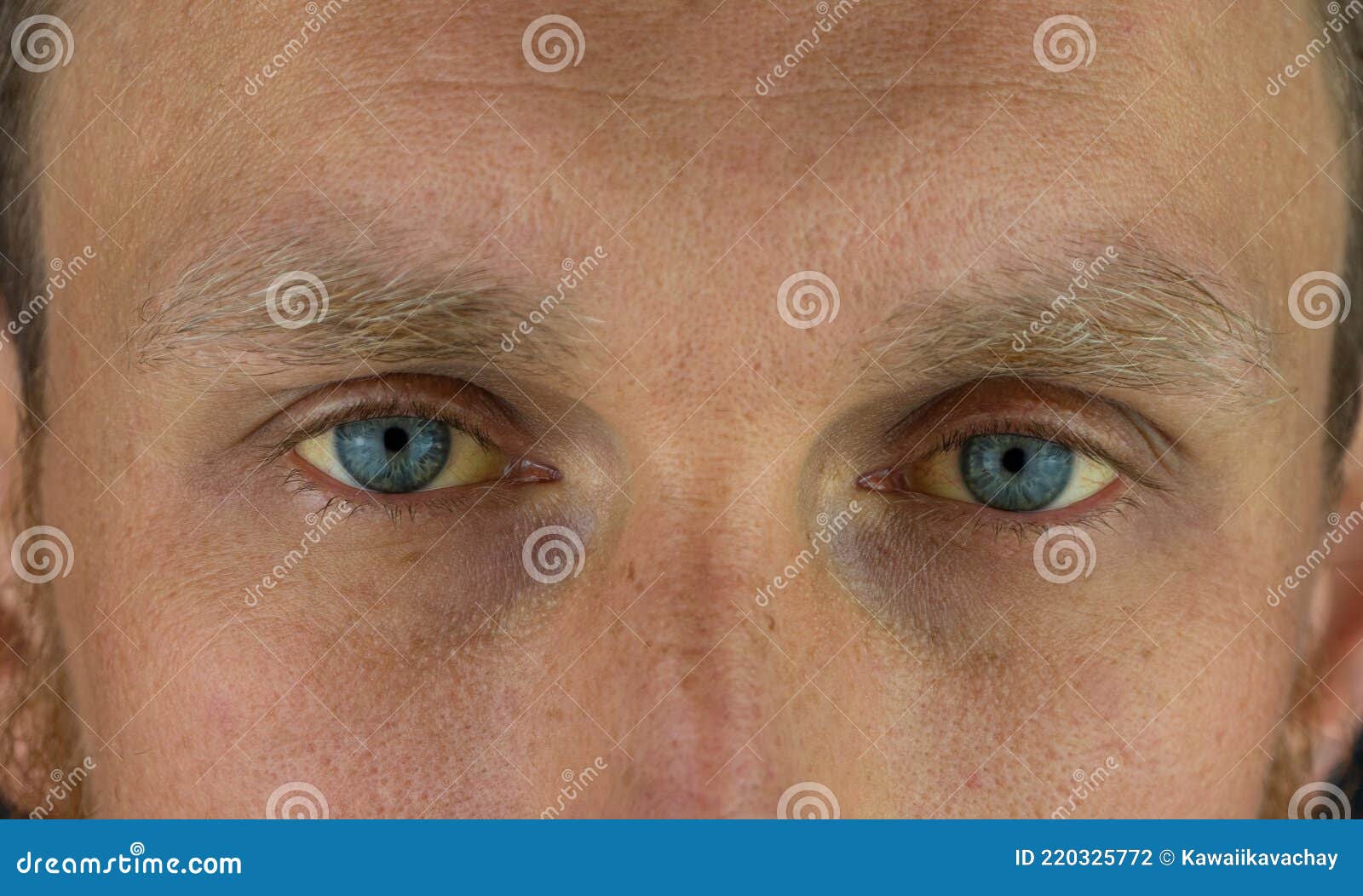 Man Eyes Obstructive Jaundice Yellow Discoloration Real People Liver  Dysfunction Icteruswith Cirrhosis Hepatitis Symptom Stock Photo - Image of  hemolytic, body: 220325772