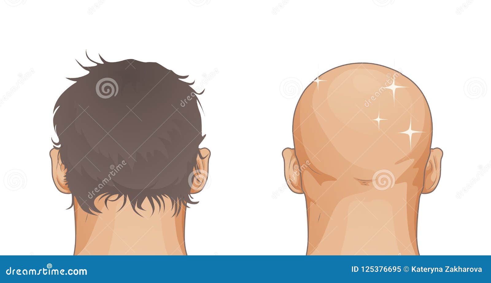 Man with Hair Loss Problem Isolated on White Background, Cartoon Style on  White Stock Illustration - Illustration of baldness, lose: 125376695