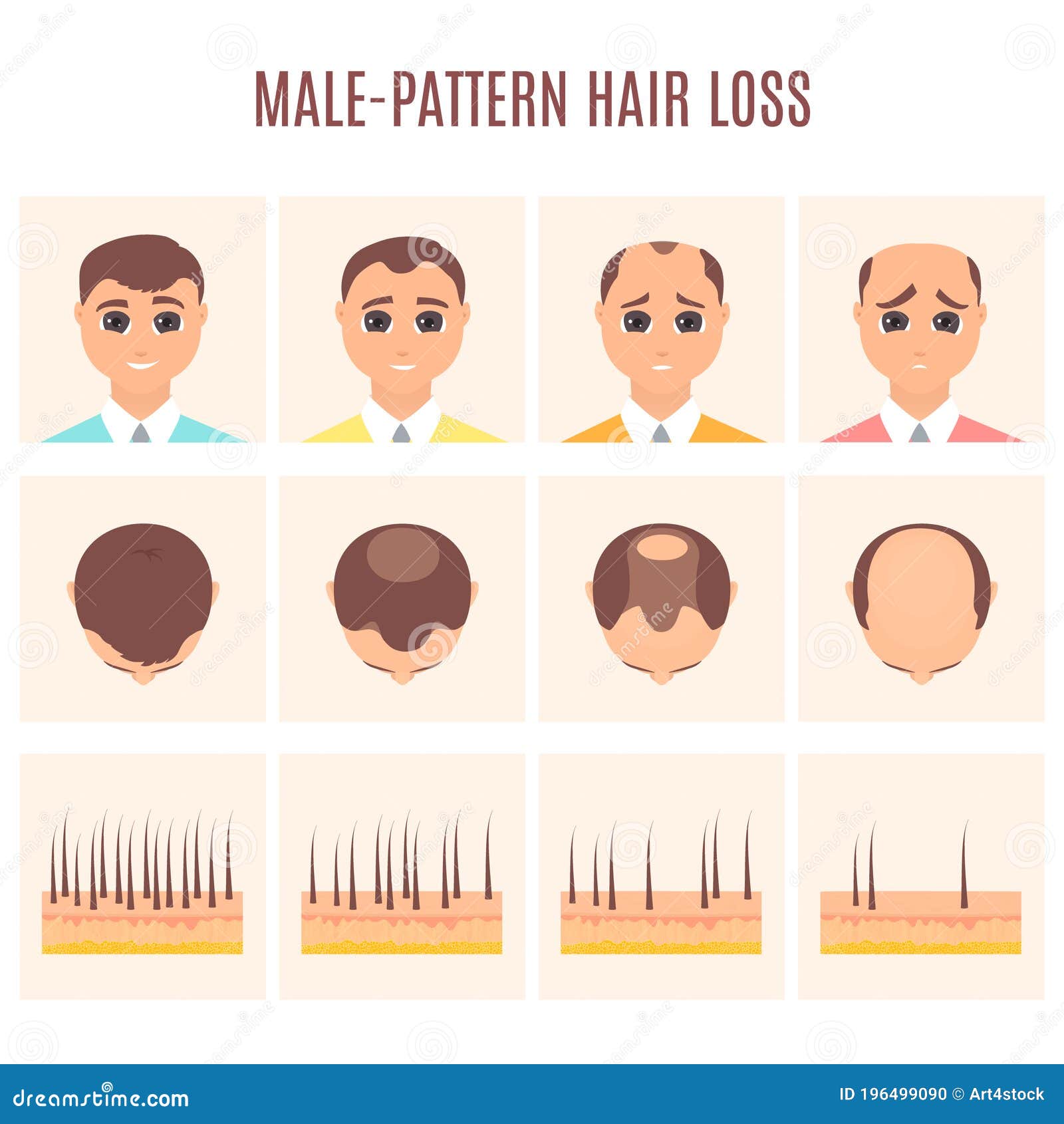 Man before and after Hair Loss Treatment in Front and Top View Stock Vector - Illustration of outcome, condition: 196499090 Man before and after Hair Loss Treatment in Front and Top View Stock Vector - Illustration of outcome, condition: 196499090