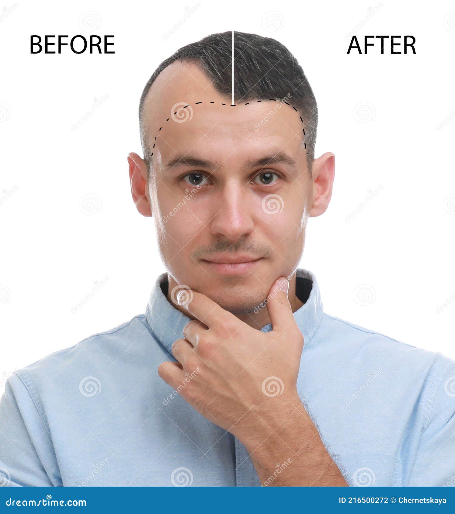 man before and after hair loss treatment on white background, collage