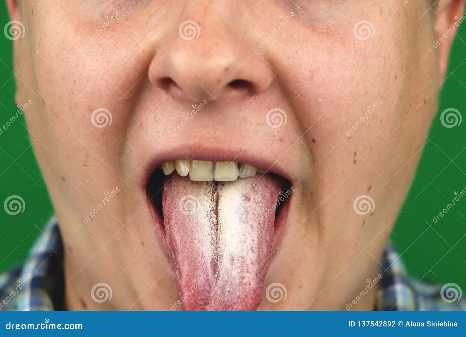 Oral candidiasis - Clinics in Dermatology, image size:1600x1157