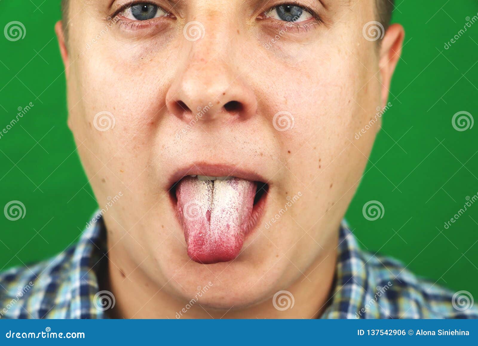 Man with Halitosis for Candida Albicans on Tongue Stock Photo Image