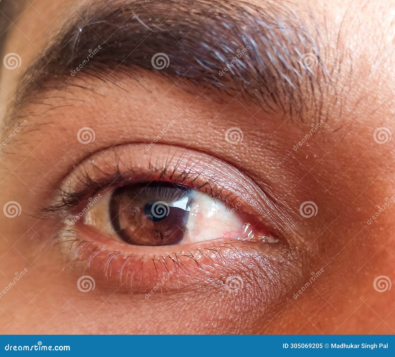 a man have pterygium is in the eye.