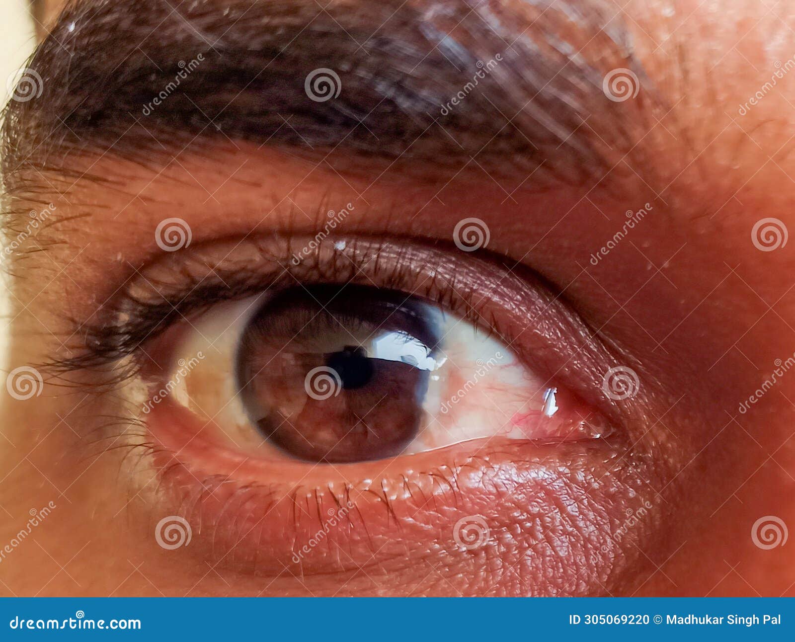 a man have pterygium is in the eye.