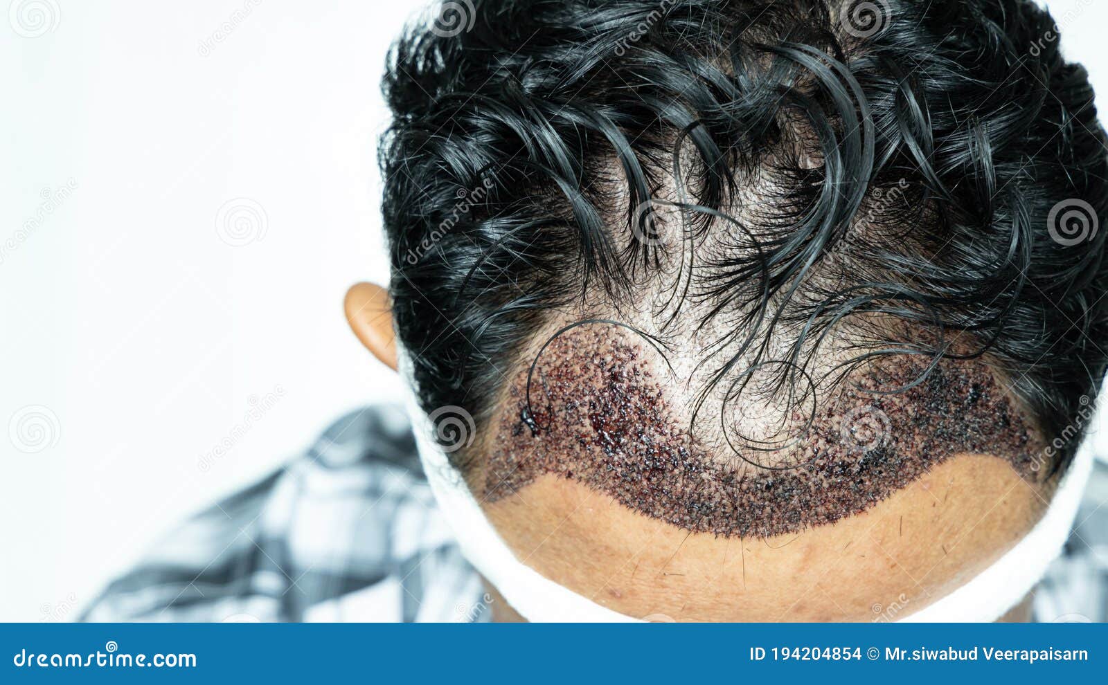 Man Head with Hair Transplant Surgery with Receding Hair Line, FUE,  Follicular Unit Extraction, Types of Hair Transplant Stock Photo - Image of  grow, doctor: 194204854