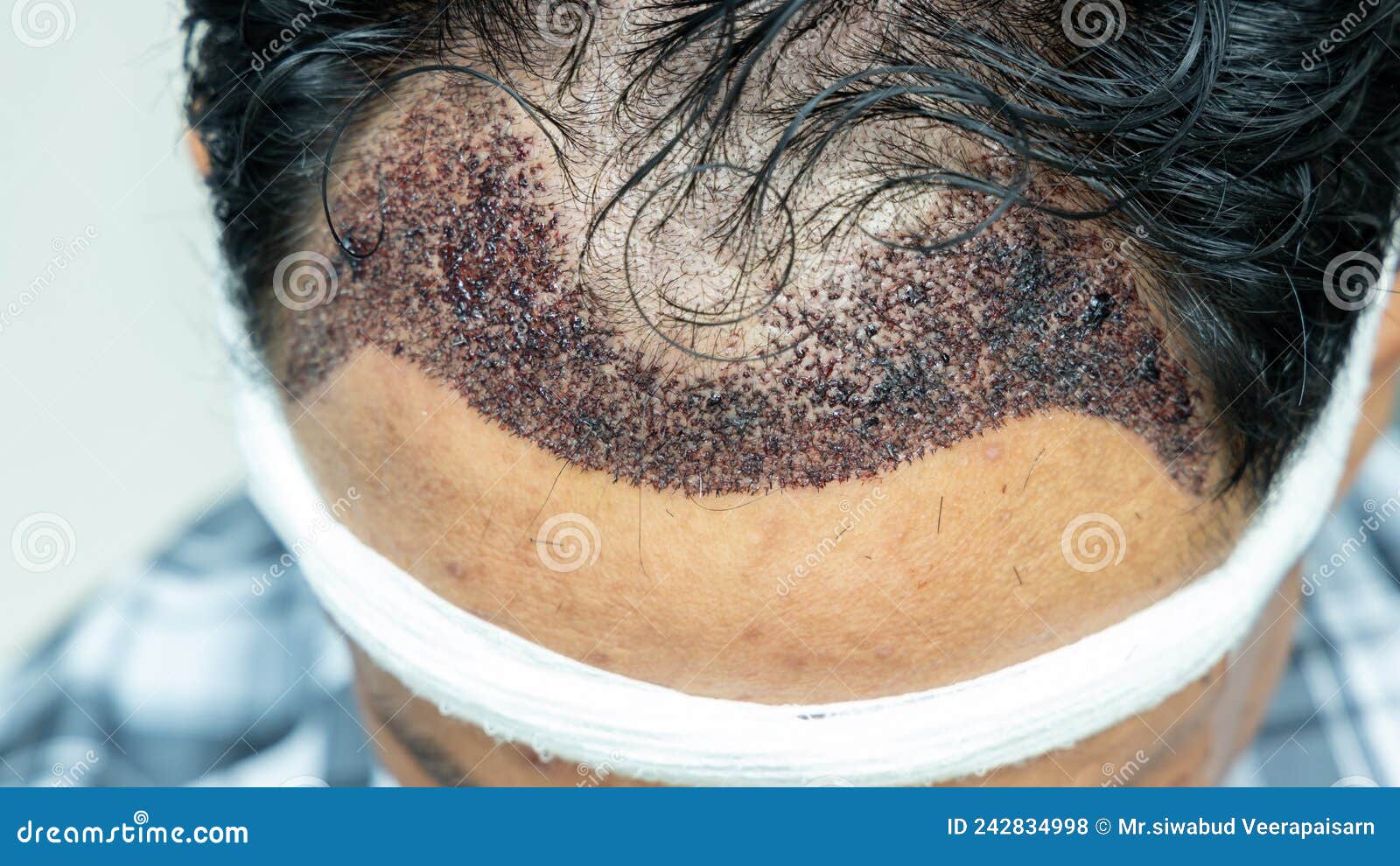 man head with hair transplant surgery with receding hair line, fue, follicular unit extraction, types of hair transplant