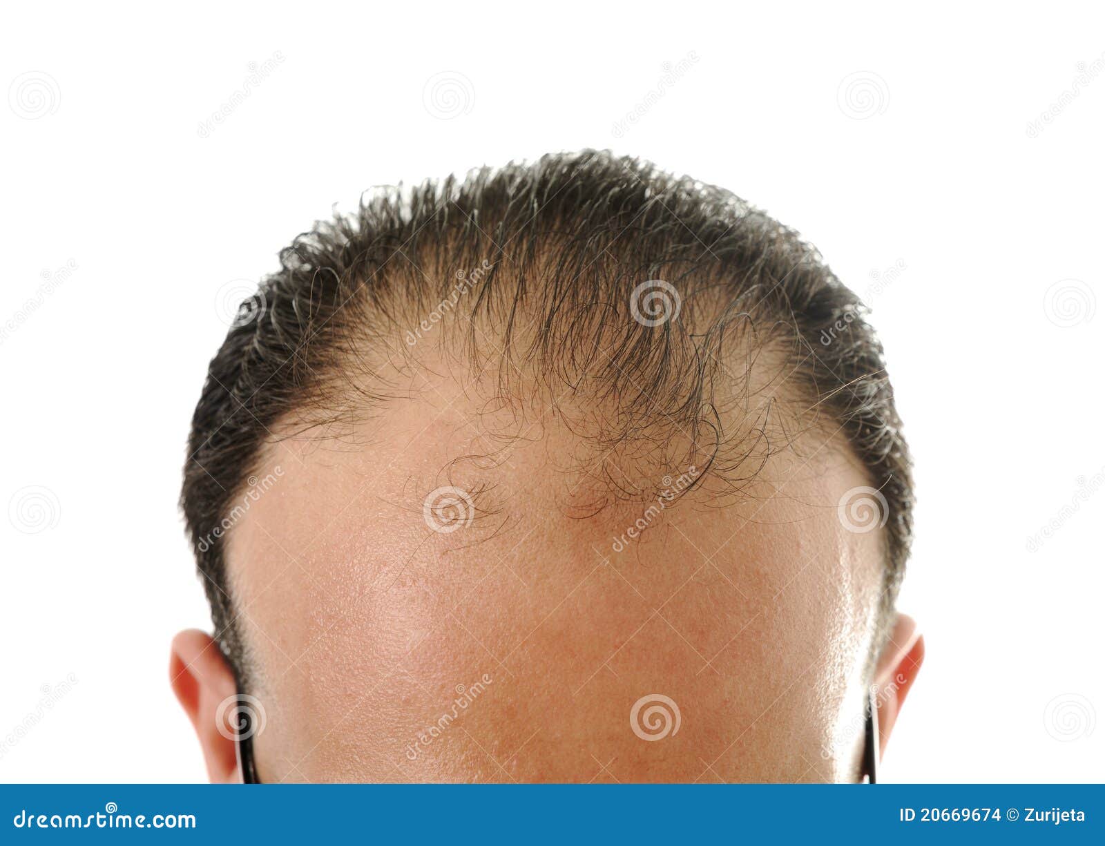 man loosing hair, baldness