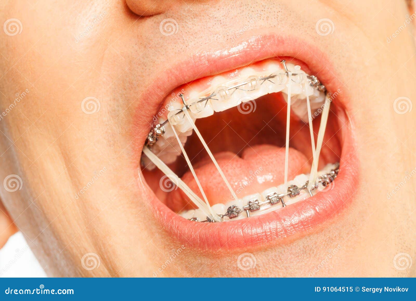 man mouth with latex rings on braces