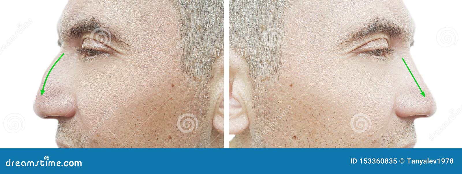 Man Nose Hump before and after Treatment Stock Image Image of collage