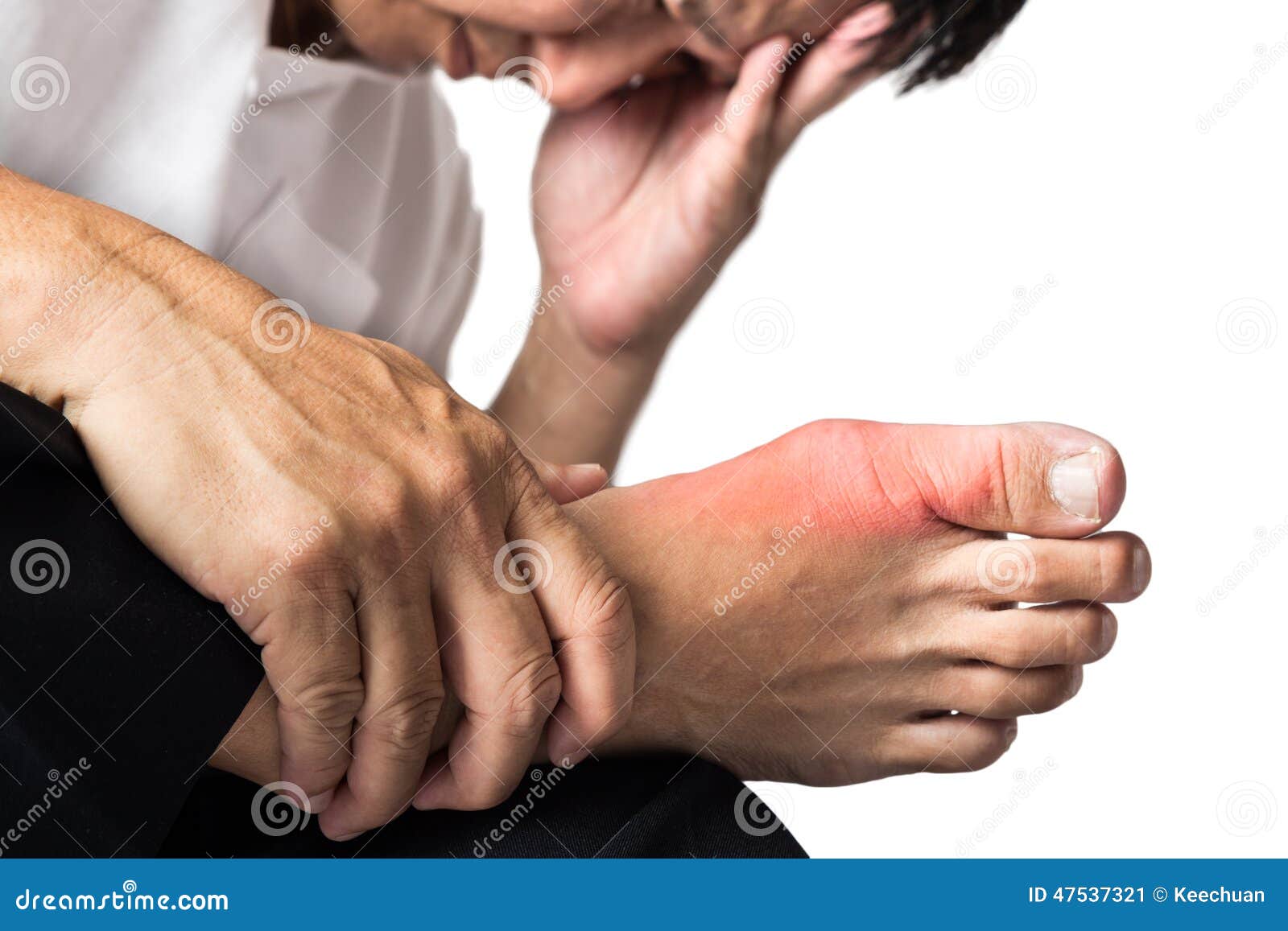 man with painful and inflamed gout on his foot, around the big toe area