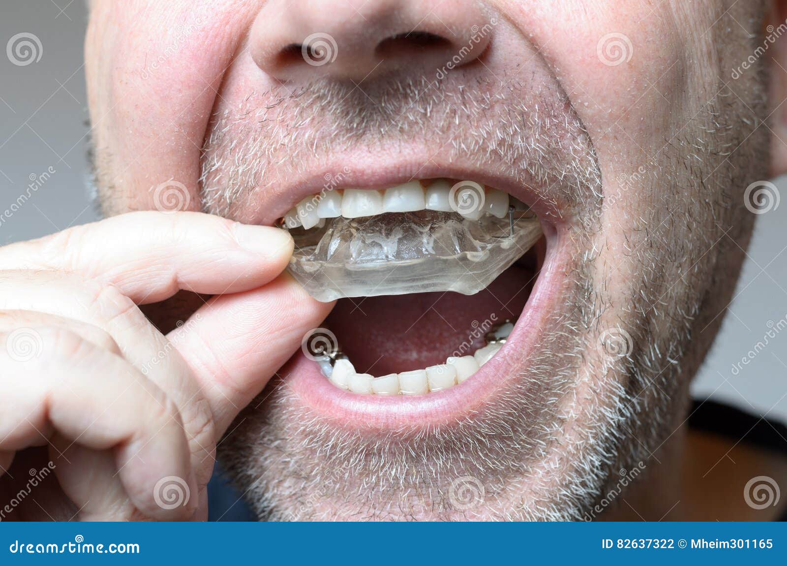 man placing a bite plate in his mouth