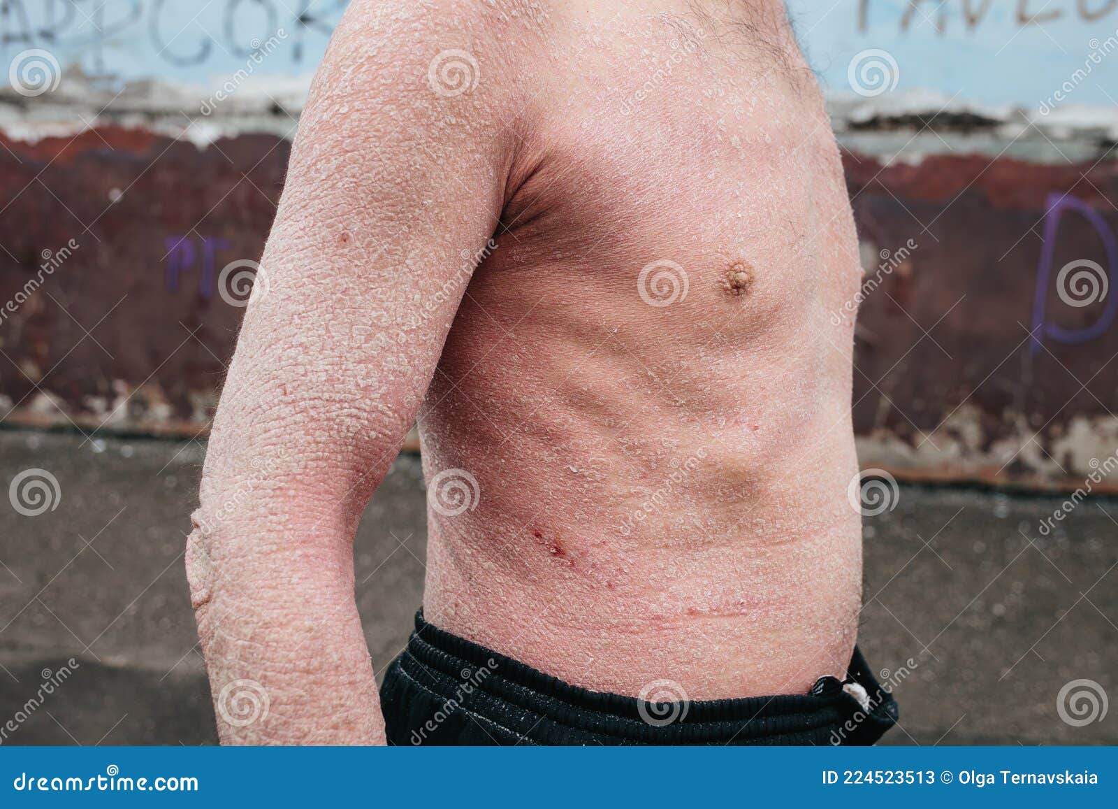 A Man With Psoriasis On His Back And Neck Scratch With His Hand