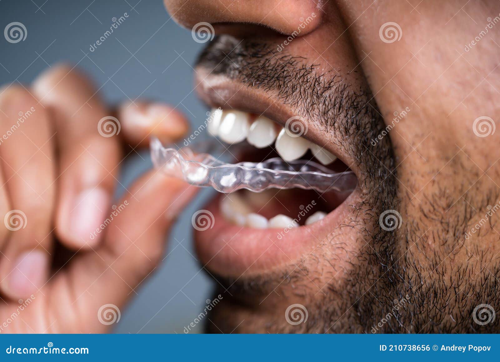 man putting transparent aligner in teeth
