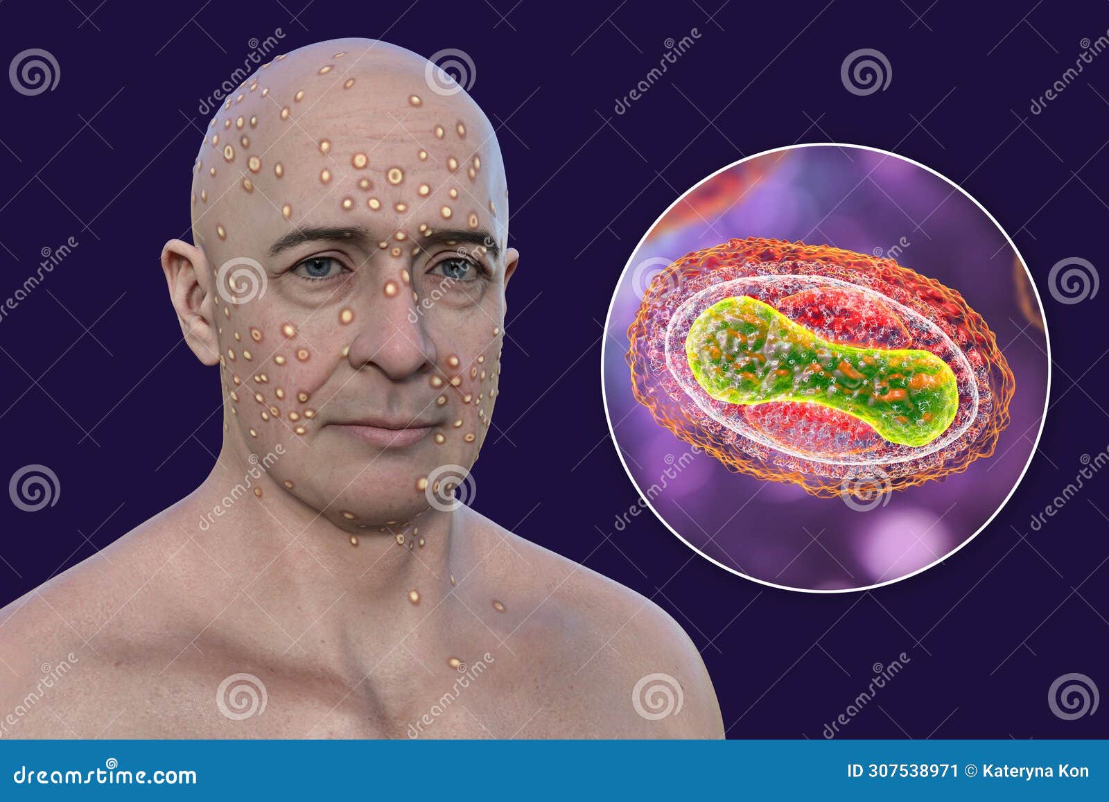 a man with rash from pox viruses, 3d 