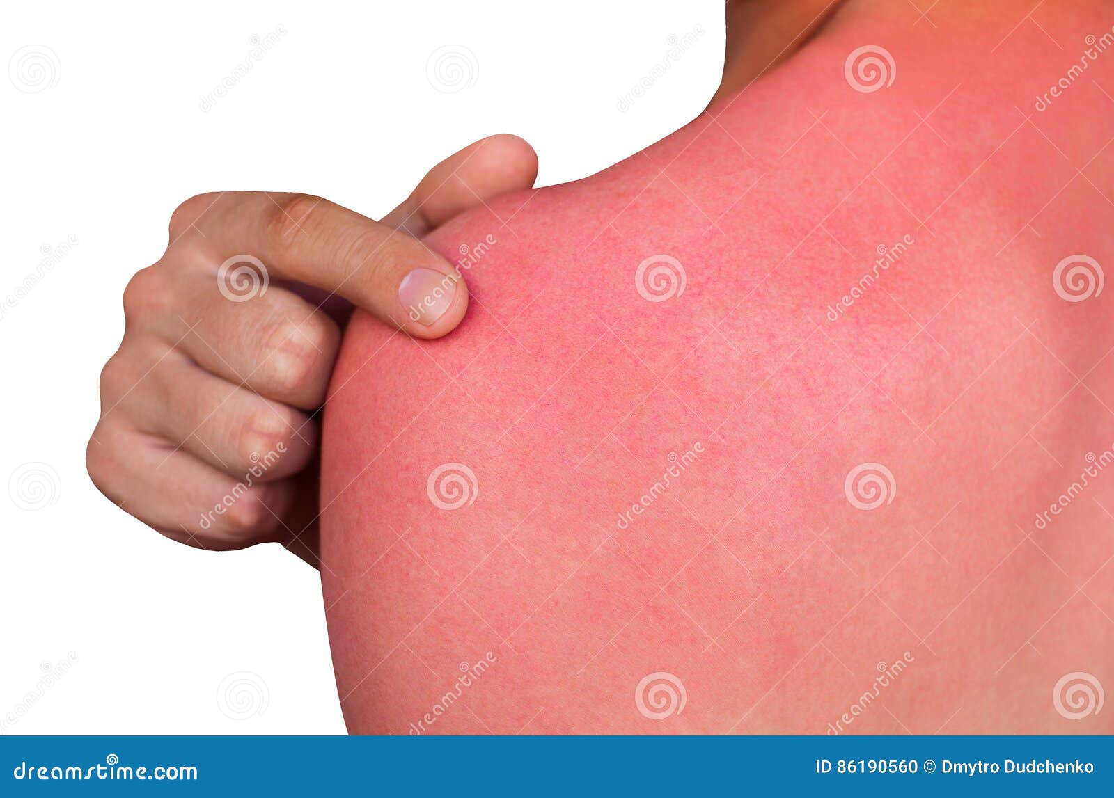 a man with reddened, itchy skin after sunburn.