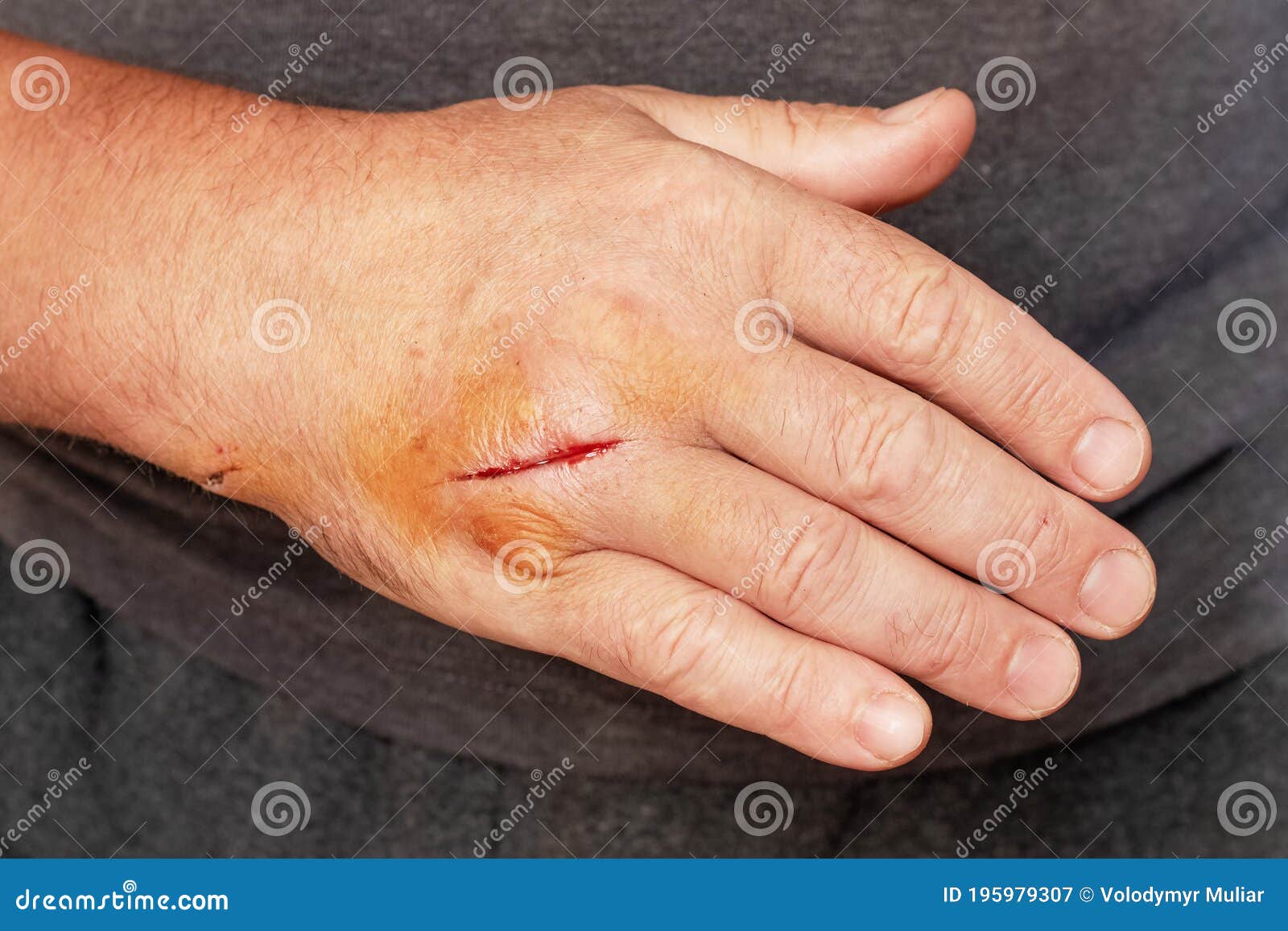 2 710 Hand Cut Wound Photos Free Royalty Free Stock Photos From Dreamstime