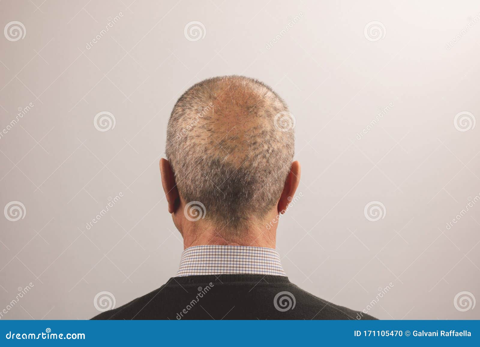 Man`s Head Who Has Done a Self Hair Transplant, Isolated Stock Photo - Image of healthcare, auto: 171105470 Man`s Head Who Has Done a Self Hair Transplant, Isolated Stock Photo - Image of healthcare, auto: 171105470