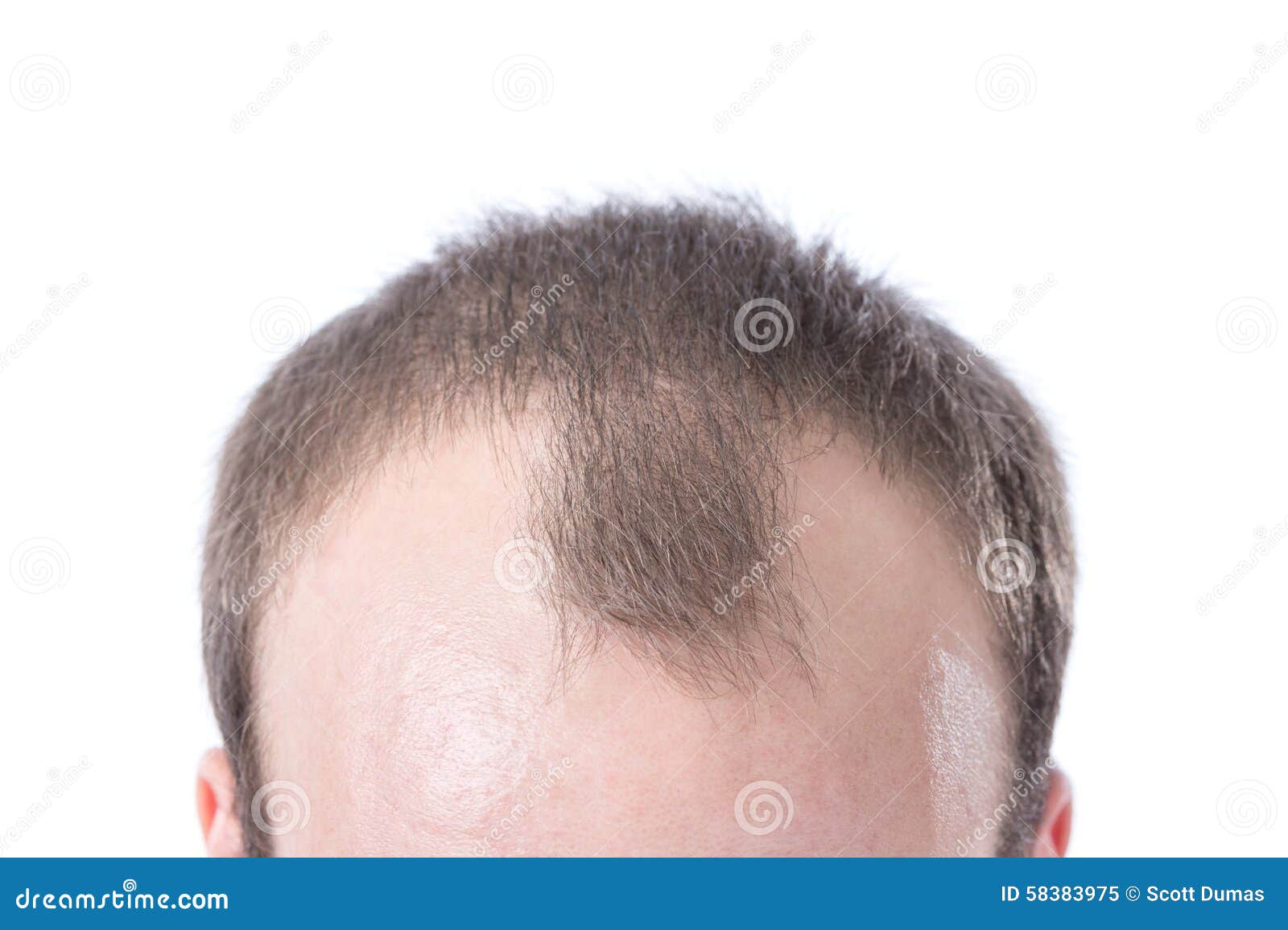 man's receding hairline