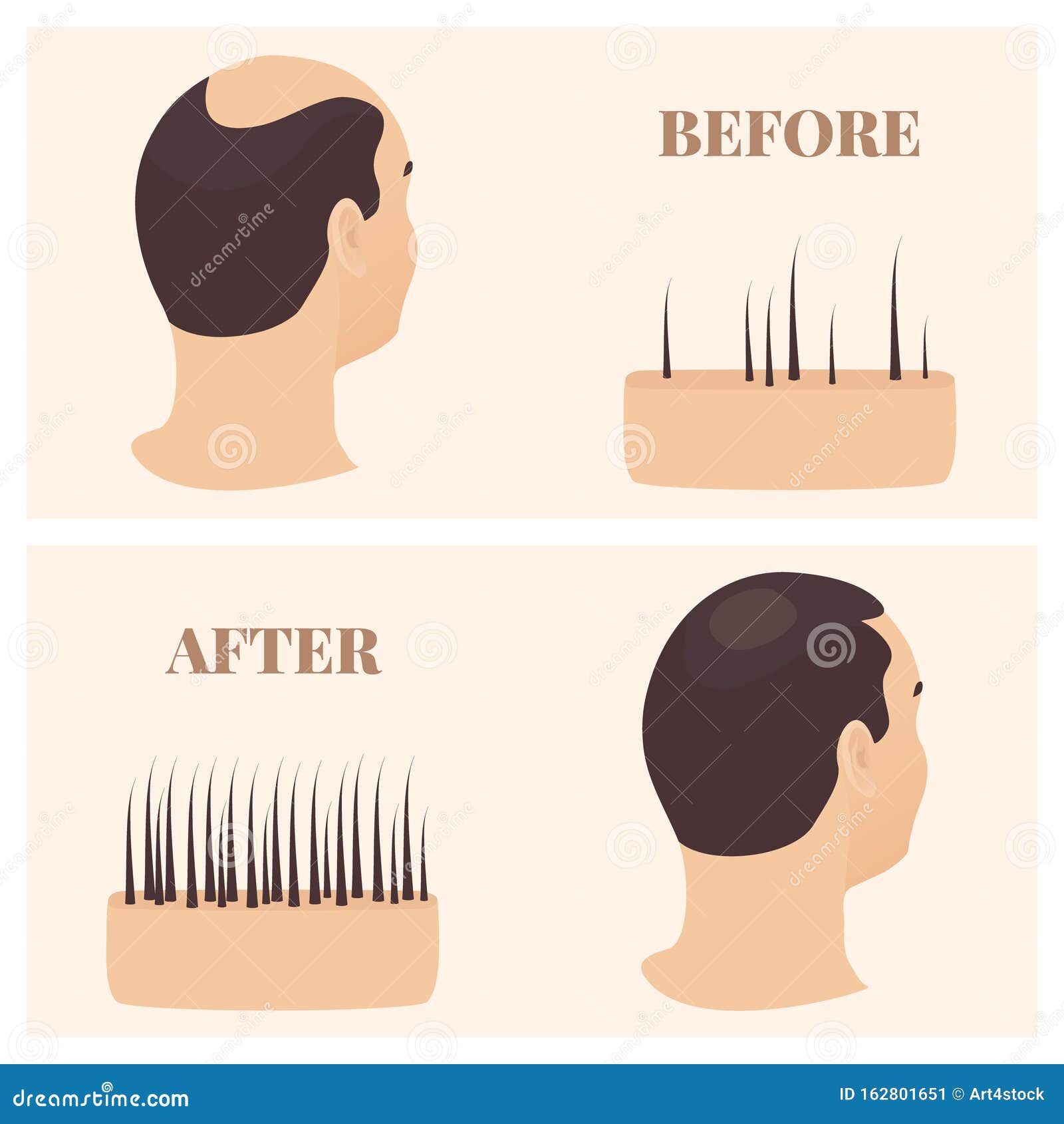 Growth Hair Stock Illustrations – 8,858 Growth Hair Stock Illustrations,  Vectors & Clipart - Dreamstime