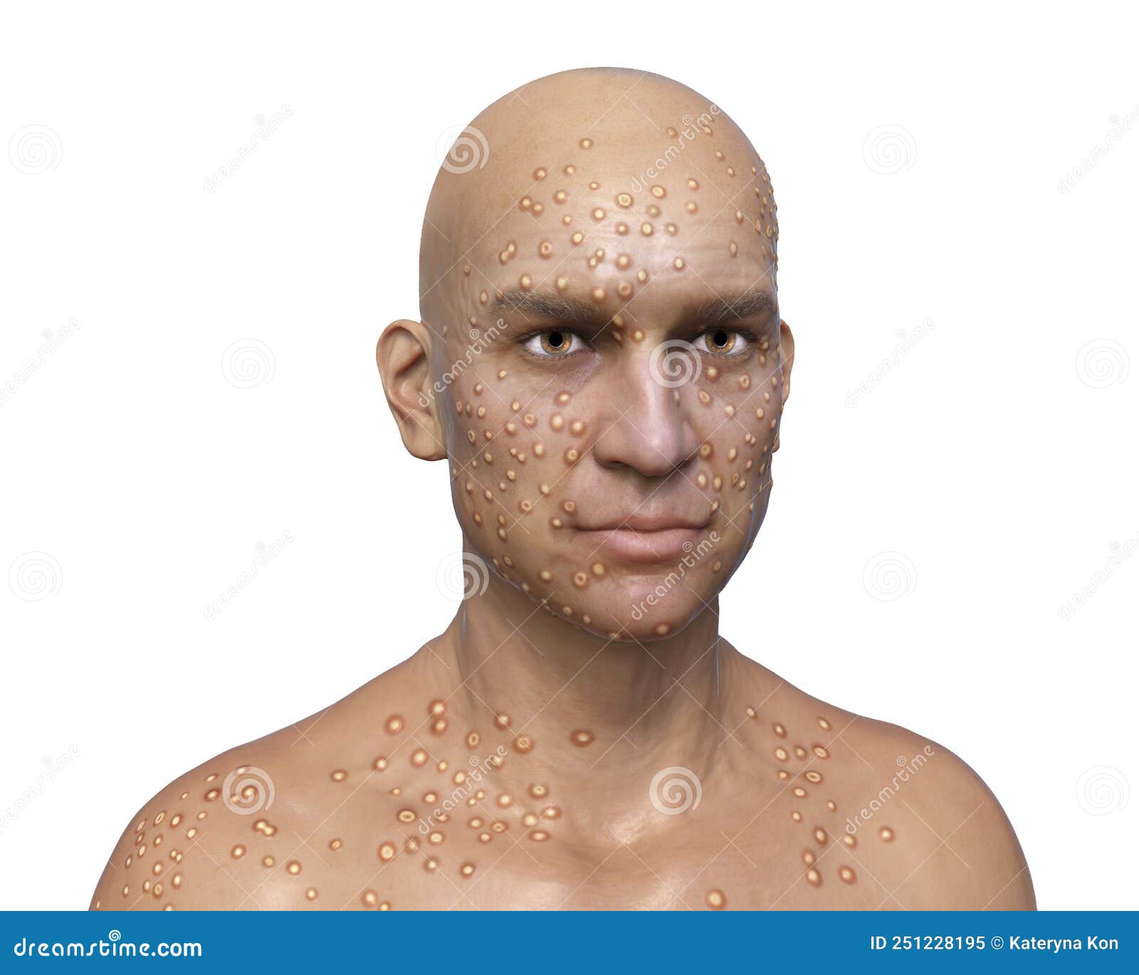 a man with smallpox disease