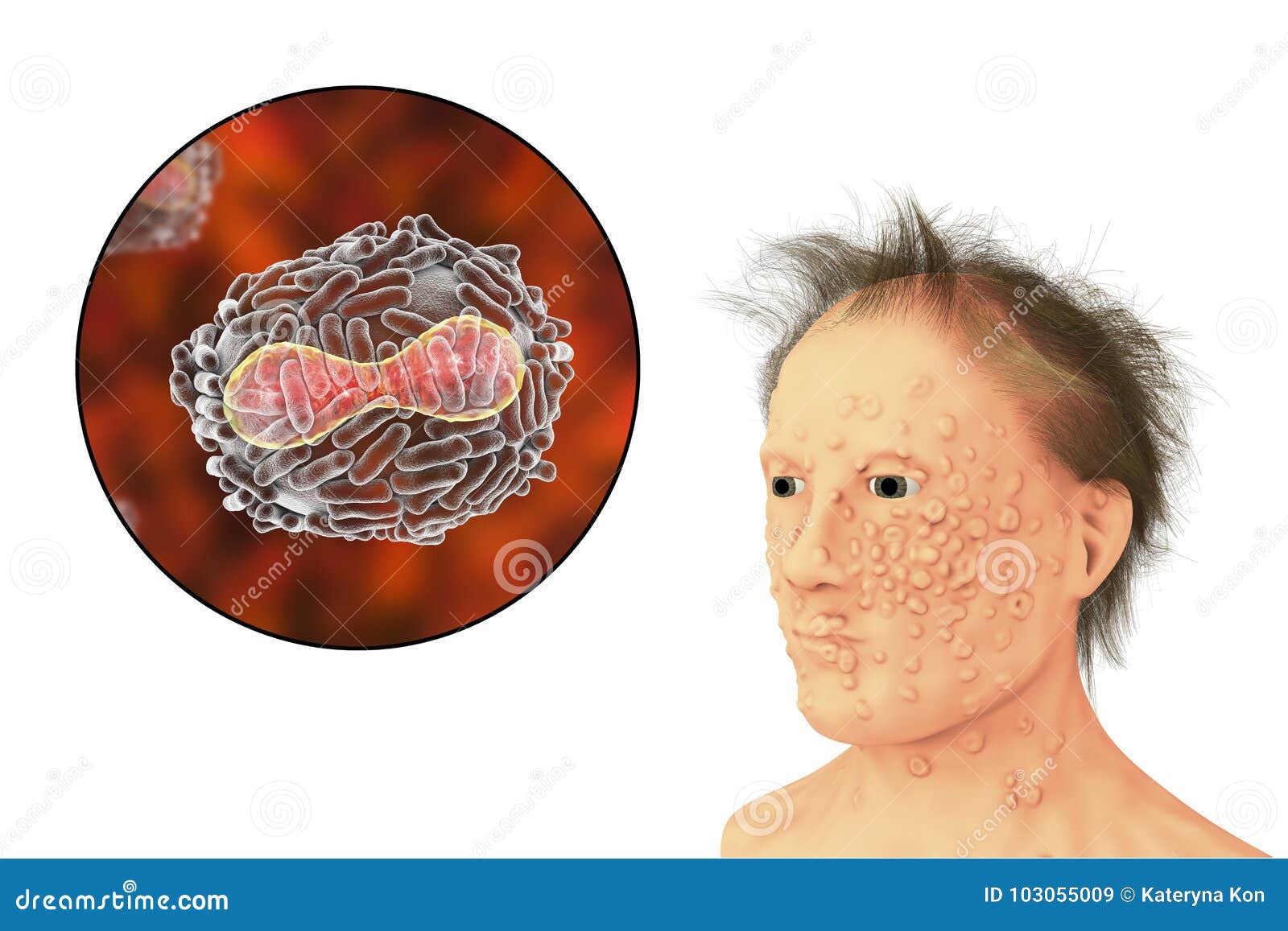 a man with smallpox infection and variola virus, a virus from orthopoxviridae family that causes smallpox