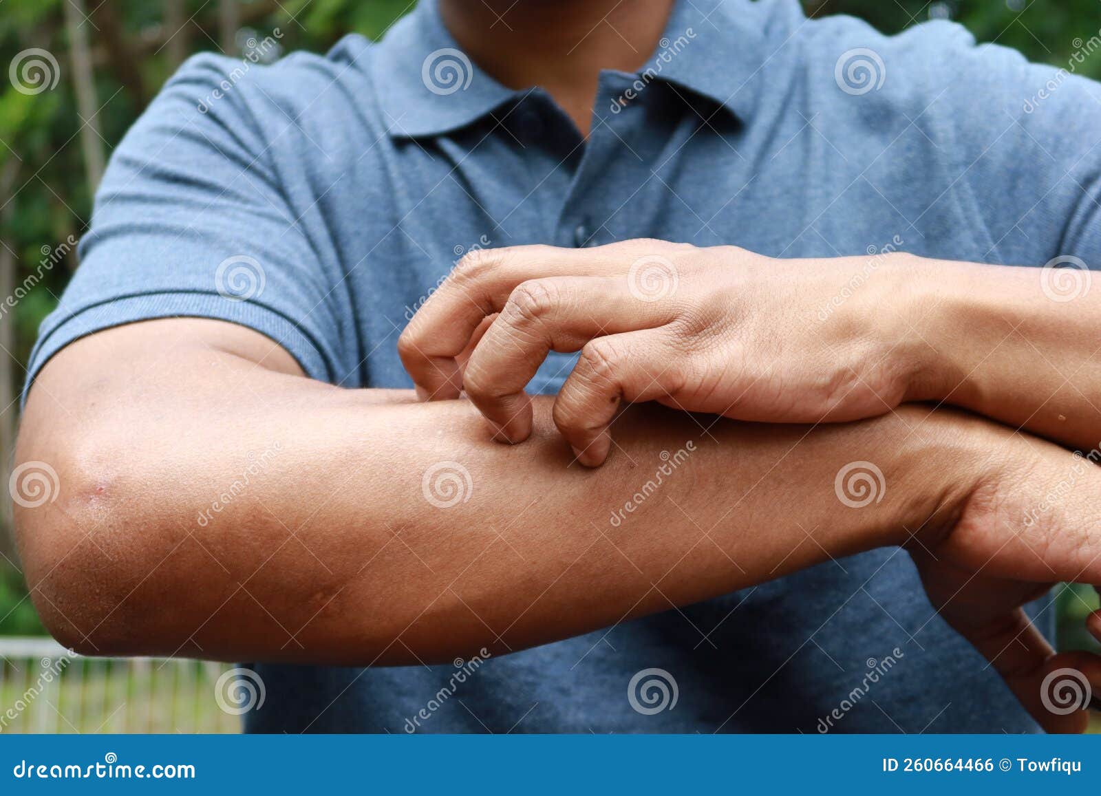 Man Suffering from Itching Skin, Close Up. Stock Photo Image of itchy, painful 260664466