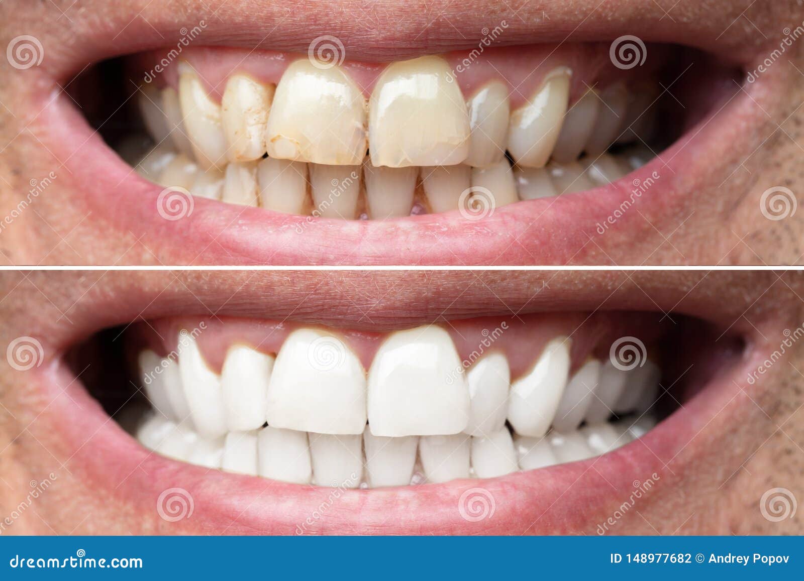 Man Teeth before and after Whitening Stock Photo Image of male