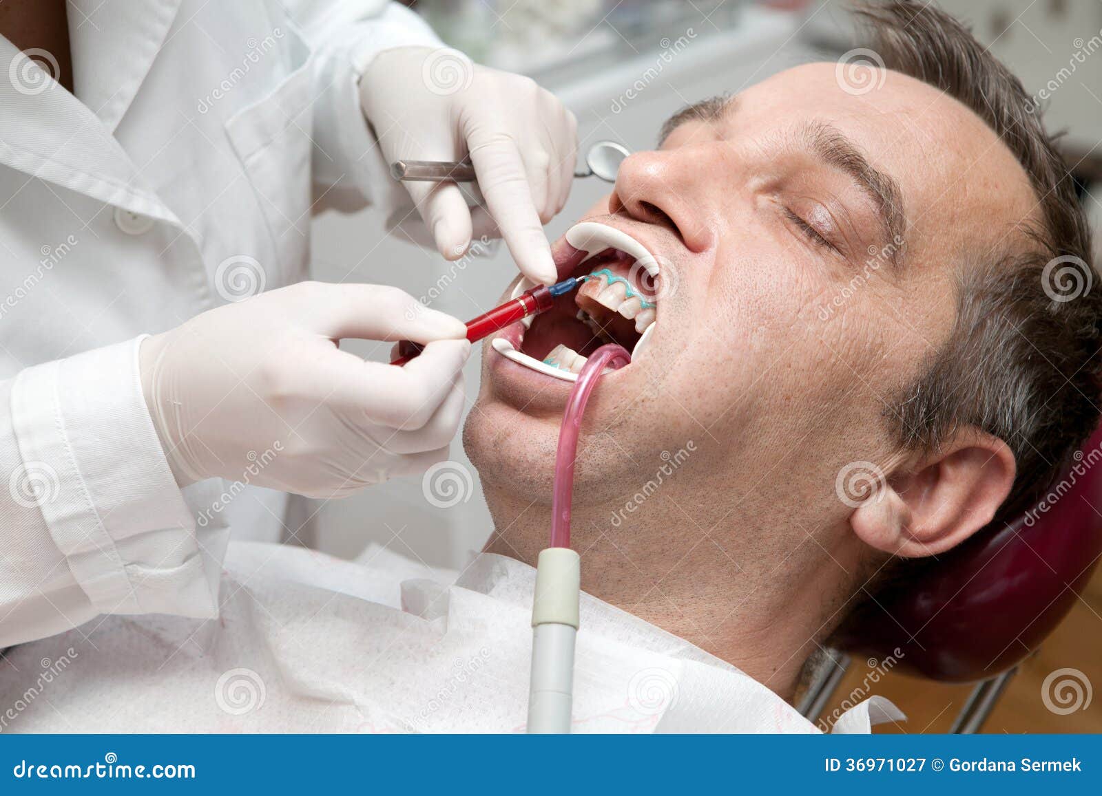 Man during Teeth Whitening Process Stock Image Image of filling, gray 36971027