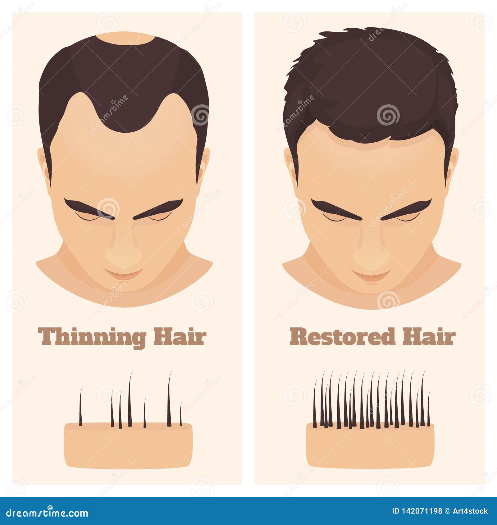 Male Pattern Alopecia Set. Medical Educational Poster. Stock Vector - Illustration of diagnostic, baldspot: 142071198 Male Pattern Alopecia Set. Medical Educational Poster. Stock Vector - Illustration of diagnostic, baldspot: 142071198