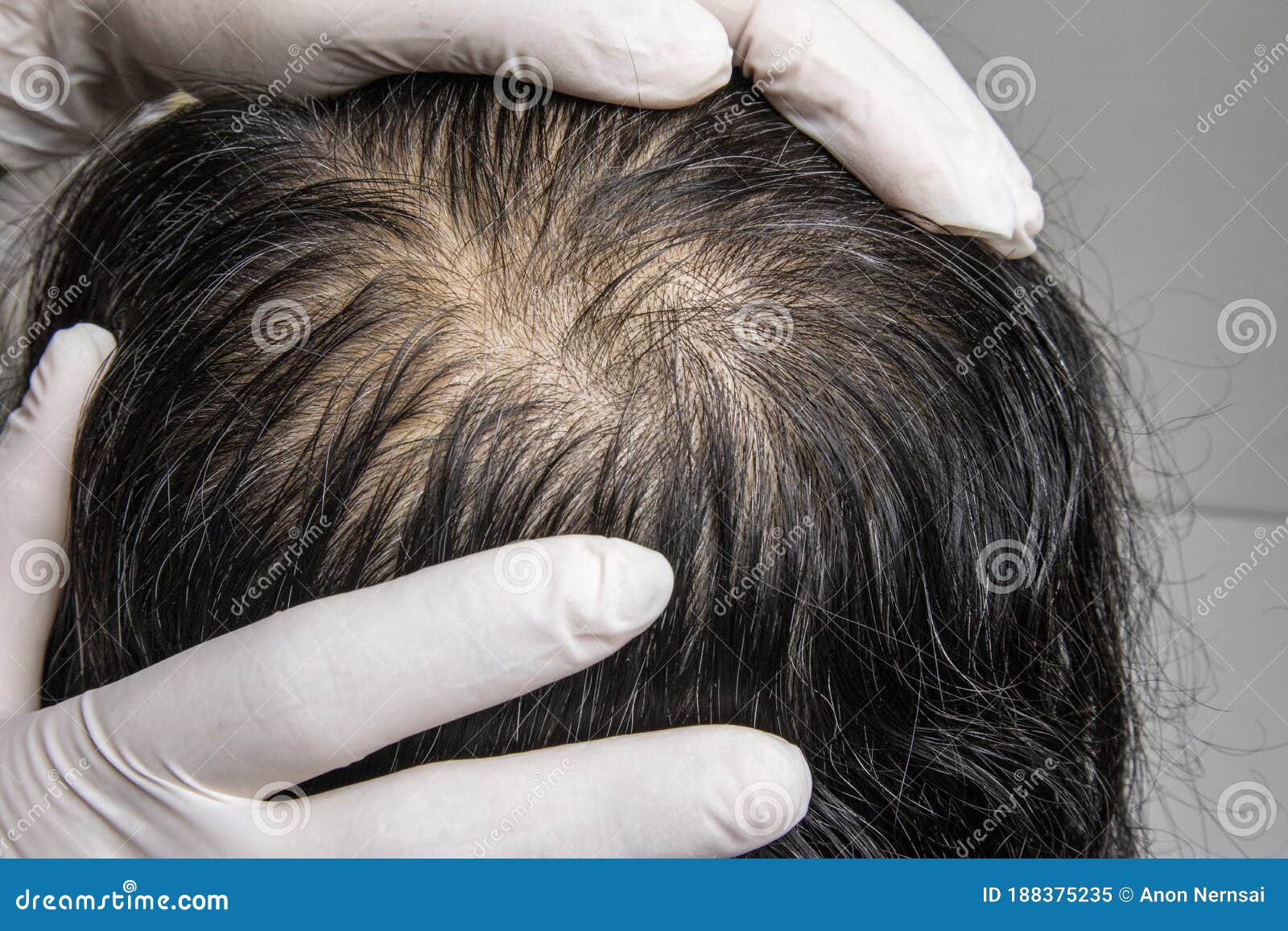 A Man Visits Dermatologist for His Hair Fall Problem. Stock Image - Image  of examination, glass: 188375235