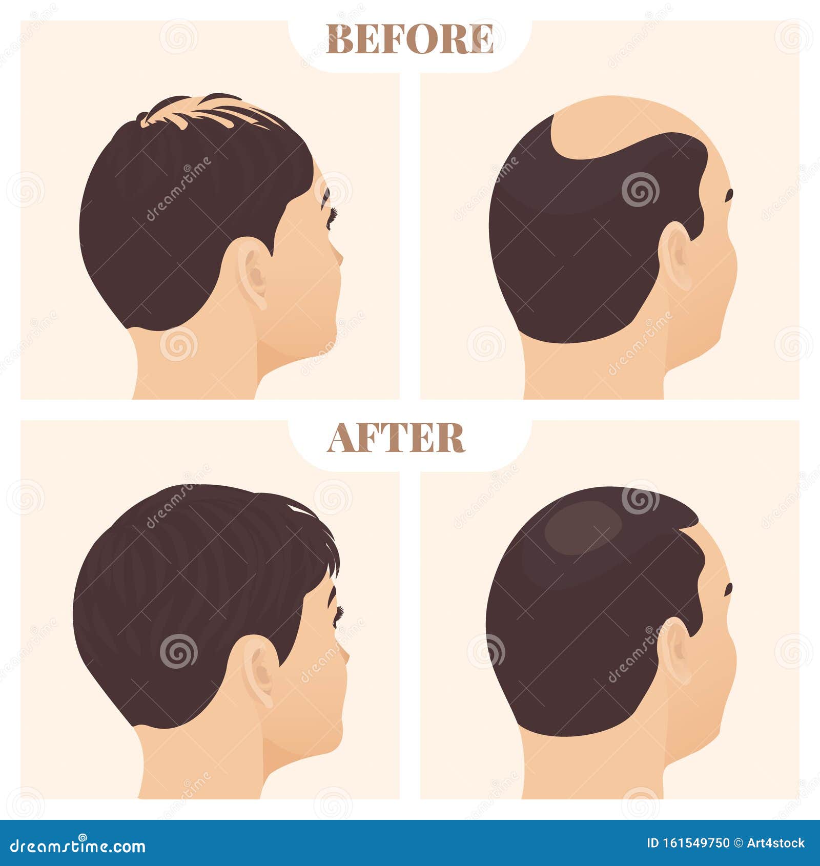 Man and Woman in Side View before and after Hair Loss Treatment Stock  Vector - Illustration of alopecia, female: 161549750