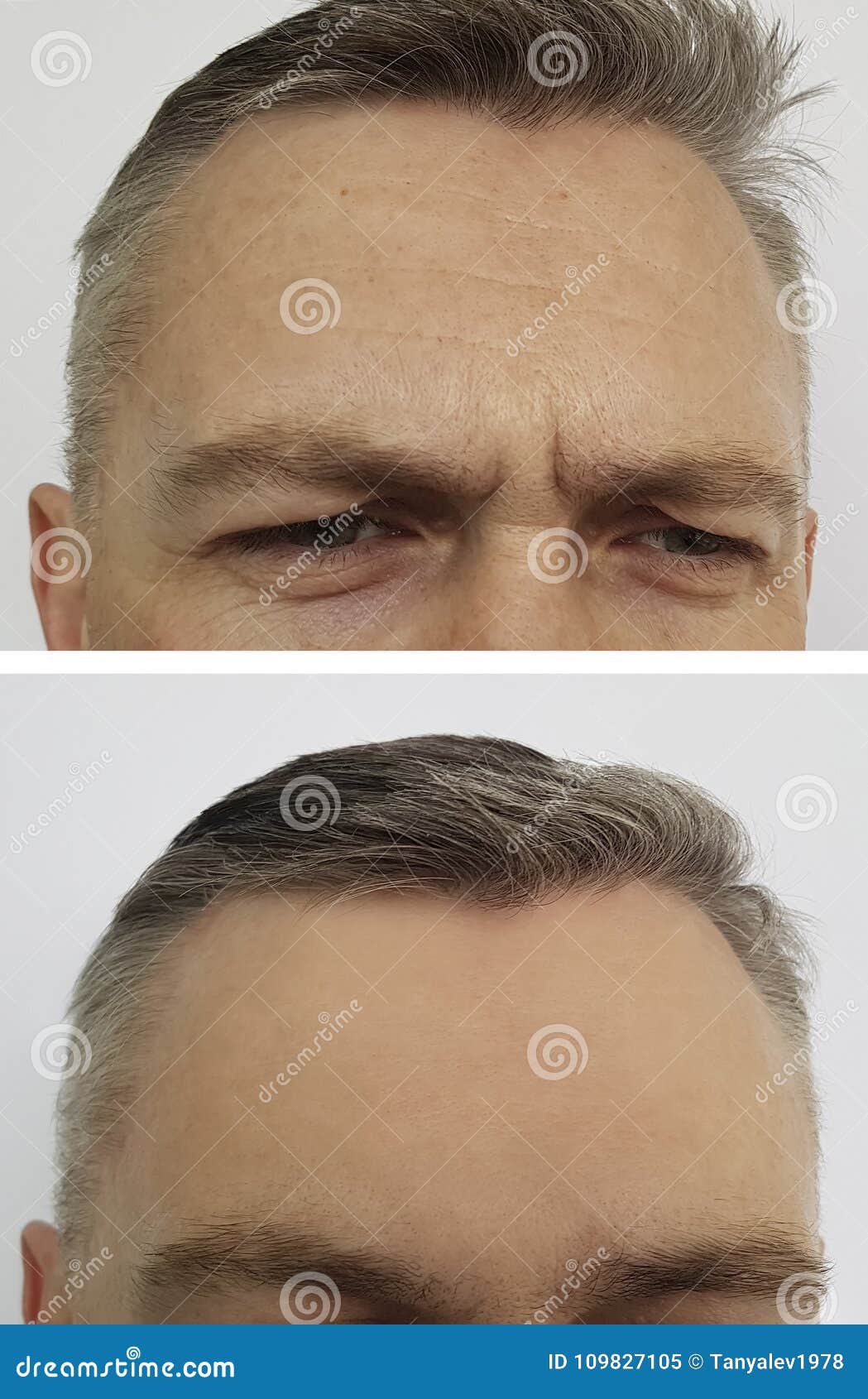 man wrinkles on the forehead before and after botox
