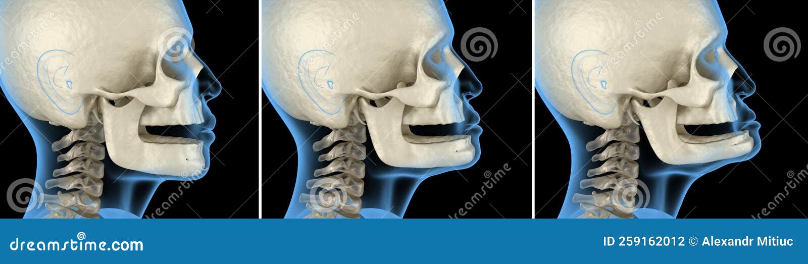 Mandibular Jaw, Bone Recession after Losing Teeth. Medically Accurate