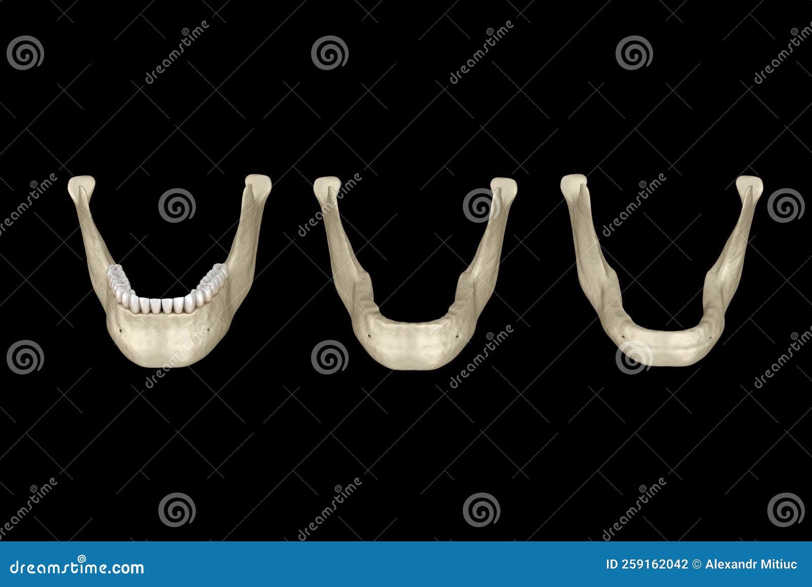 Mandibular Jaw, Bone Recession after Losing Teeth. Medically Accurate