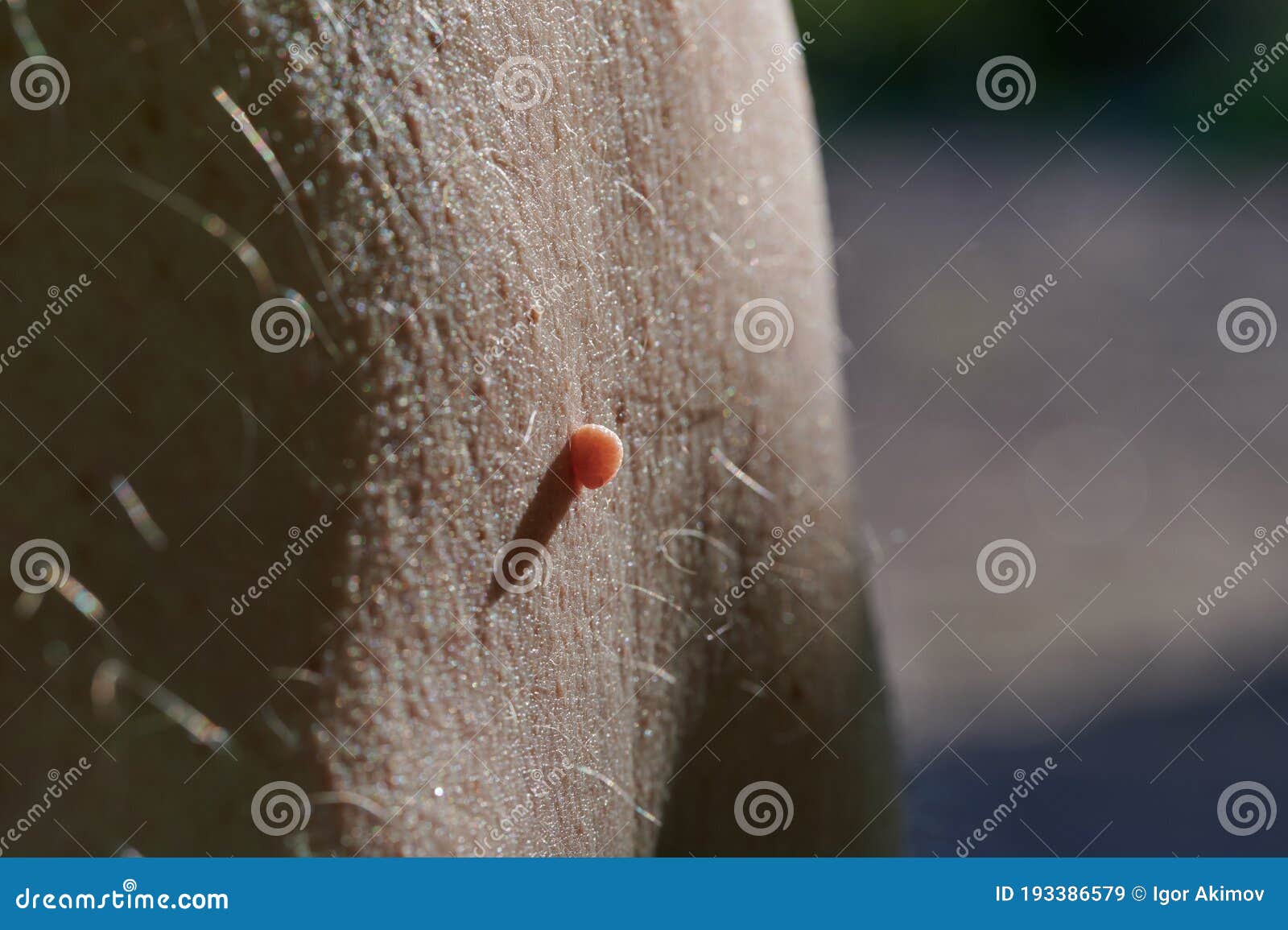 papiloma human hombres o numesc infecție cu vierme