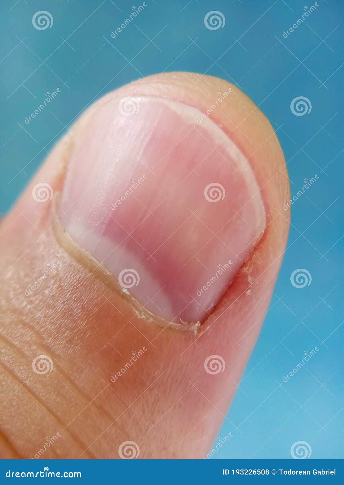 Haut schält sich fingerspitzen Was bewirkt,