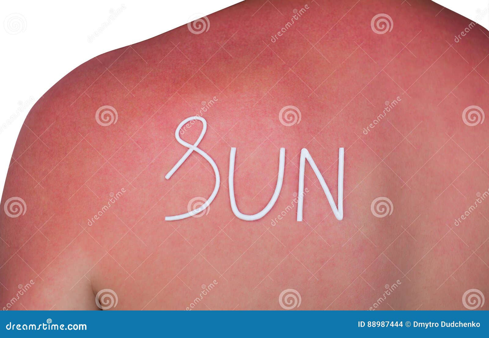 Mann Mit Geroteter Juckender Haut Nach Sonnenbrand Creme Auf Der Ruckseite Stockfoto Bild Von Creme Sonnenbrand 7444
