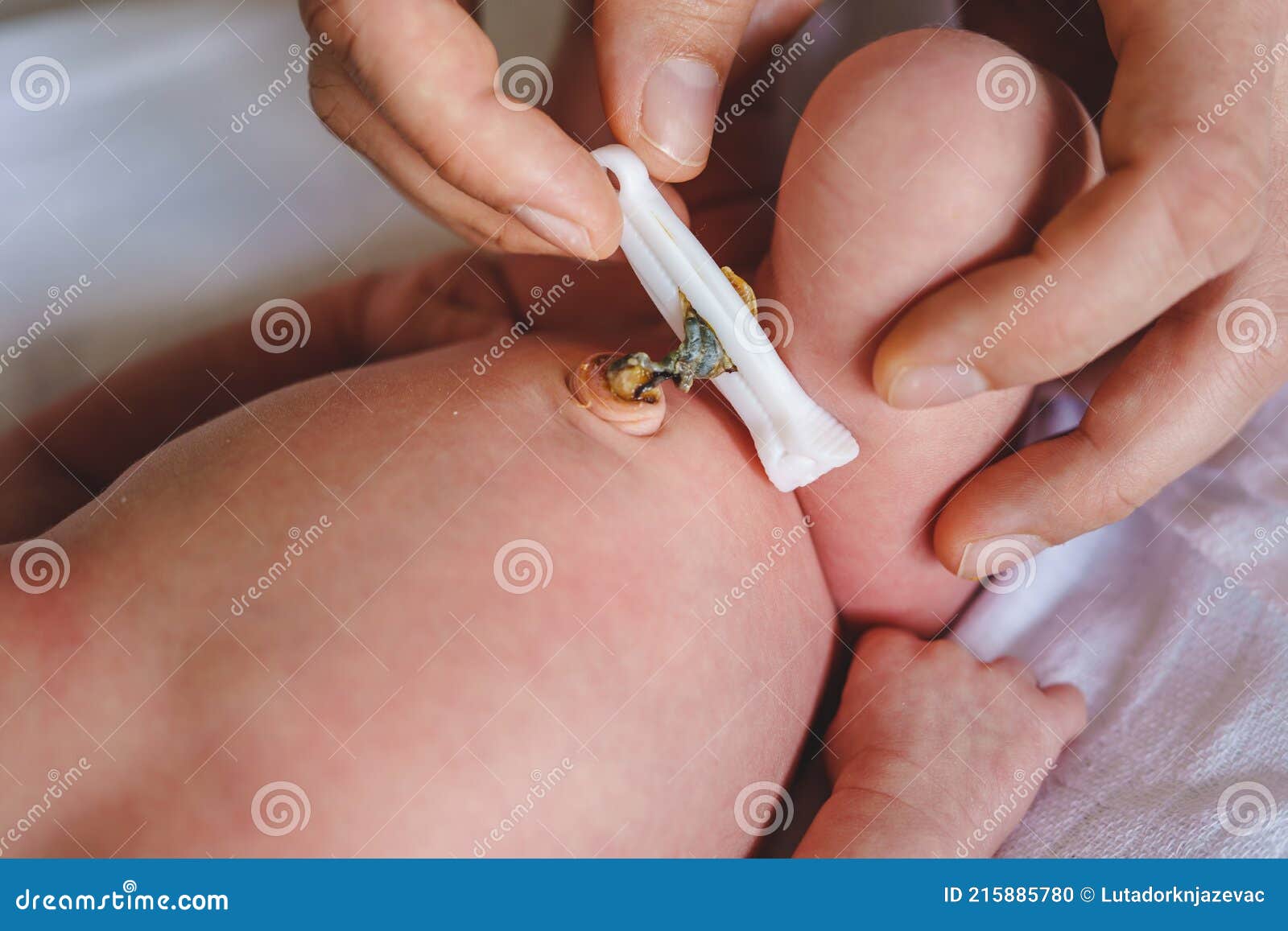 Manos De Padre Hombre Desconocido Cuidando Cordón Umbilical Con Pinza De  Recién Nacido Cuidado Neonatal Padre Ombligo Limpio De Be Foto de archivo -  Imagen de infante, muchachos: 215885780